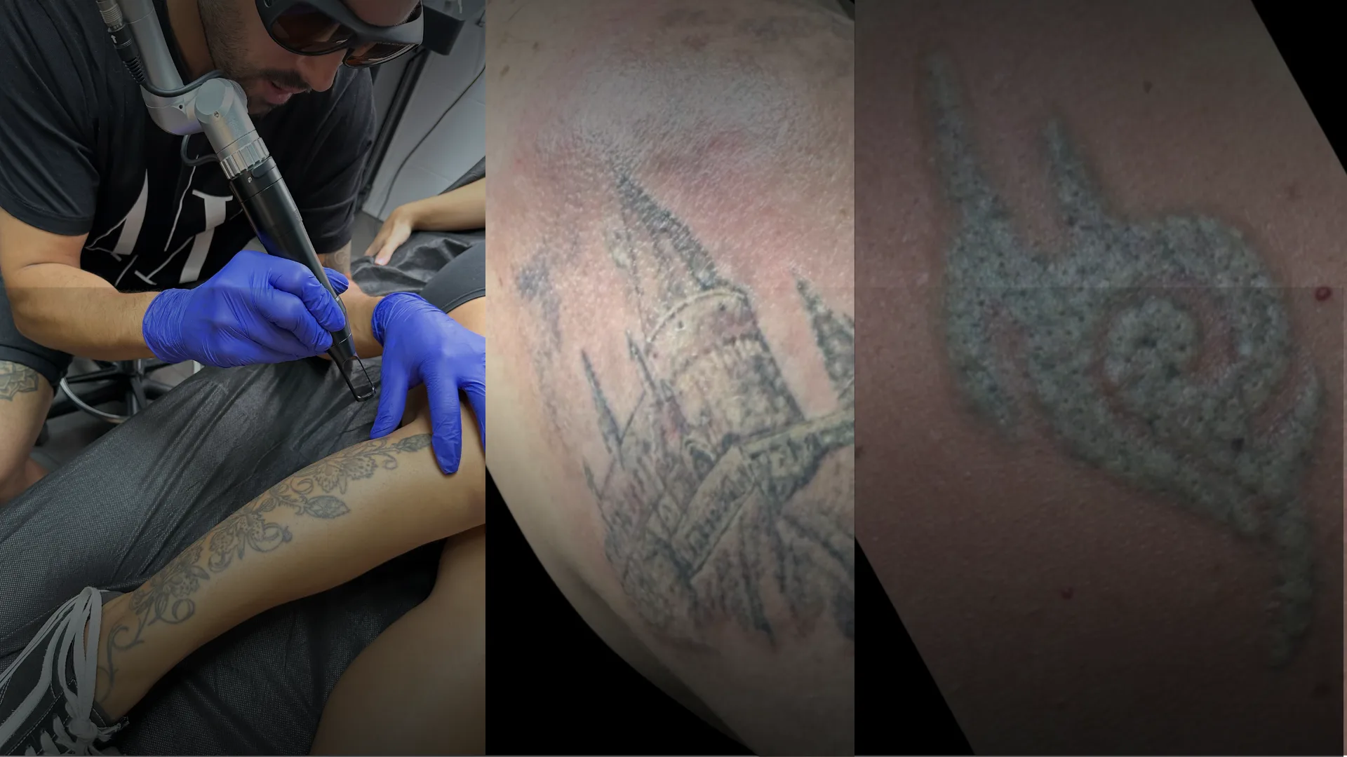 Cuidados Despues de Eliminar un Tatuaje con Laser: Guia Completa